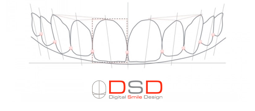 Diseño Digital de la Sonrisa