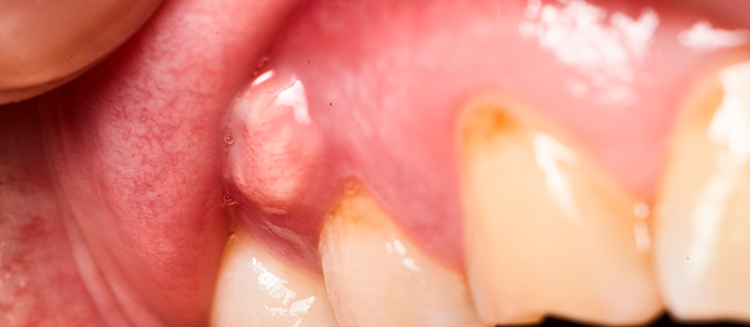 bulto en la encía de un paciente