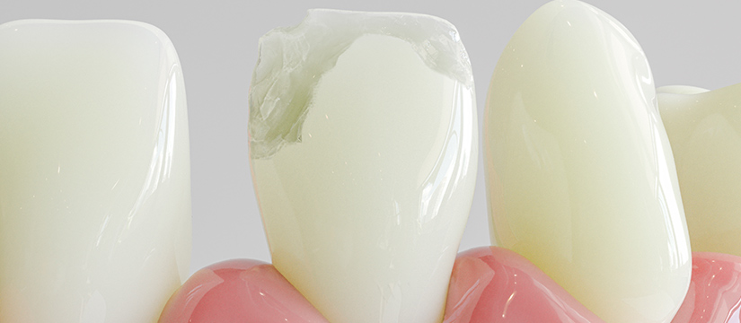 caries blancas en dientes