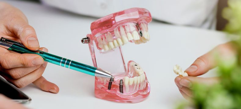 tipos de implantes dentales