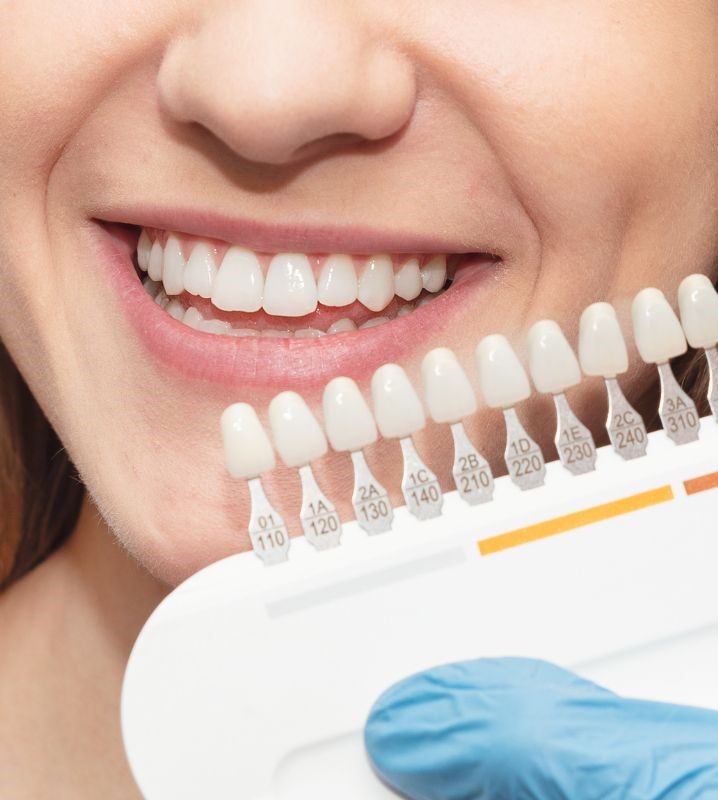 Blanqueamiento dental