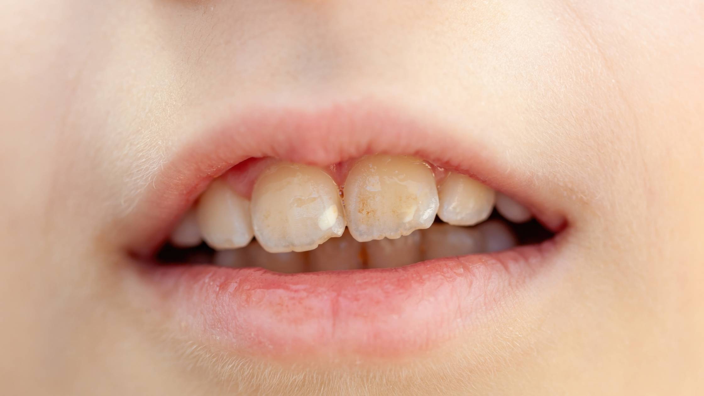 Niño con dientes con fluorosis dental