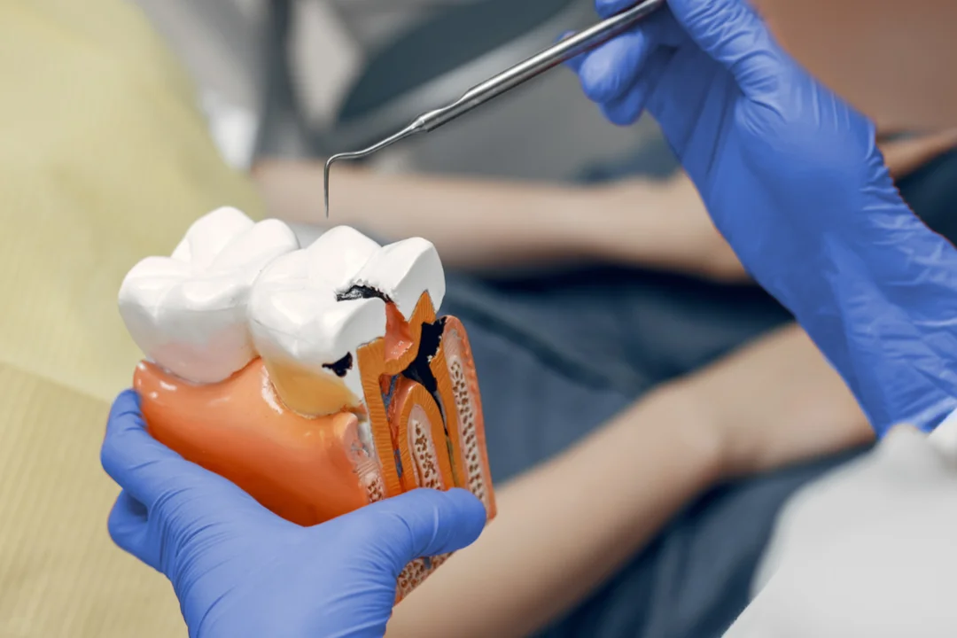 Tratamiento de caries profundas