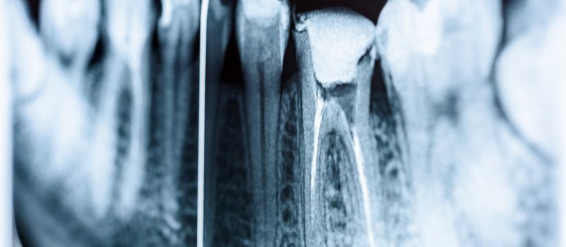 Radiografía de una muela que necesita una endodoncia