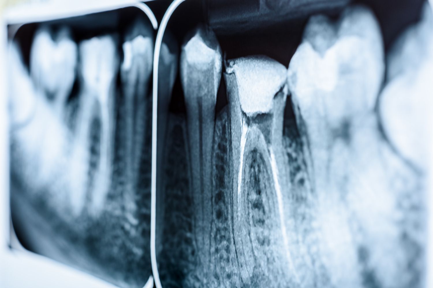 Radiografía de una muela que necesita una endodoncia