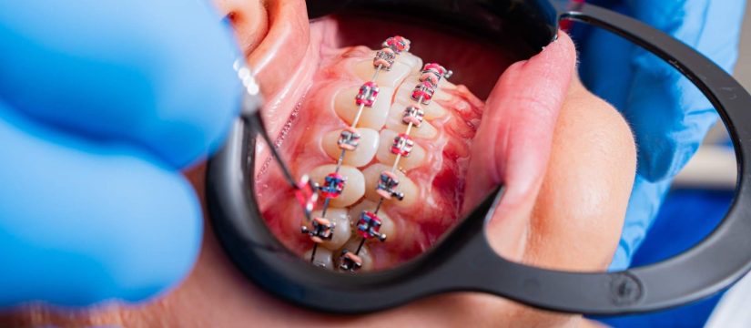 Persona en una revisión de brackets