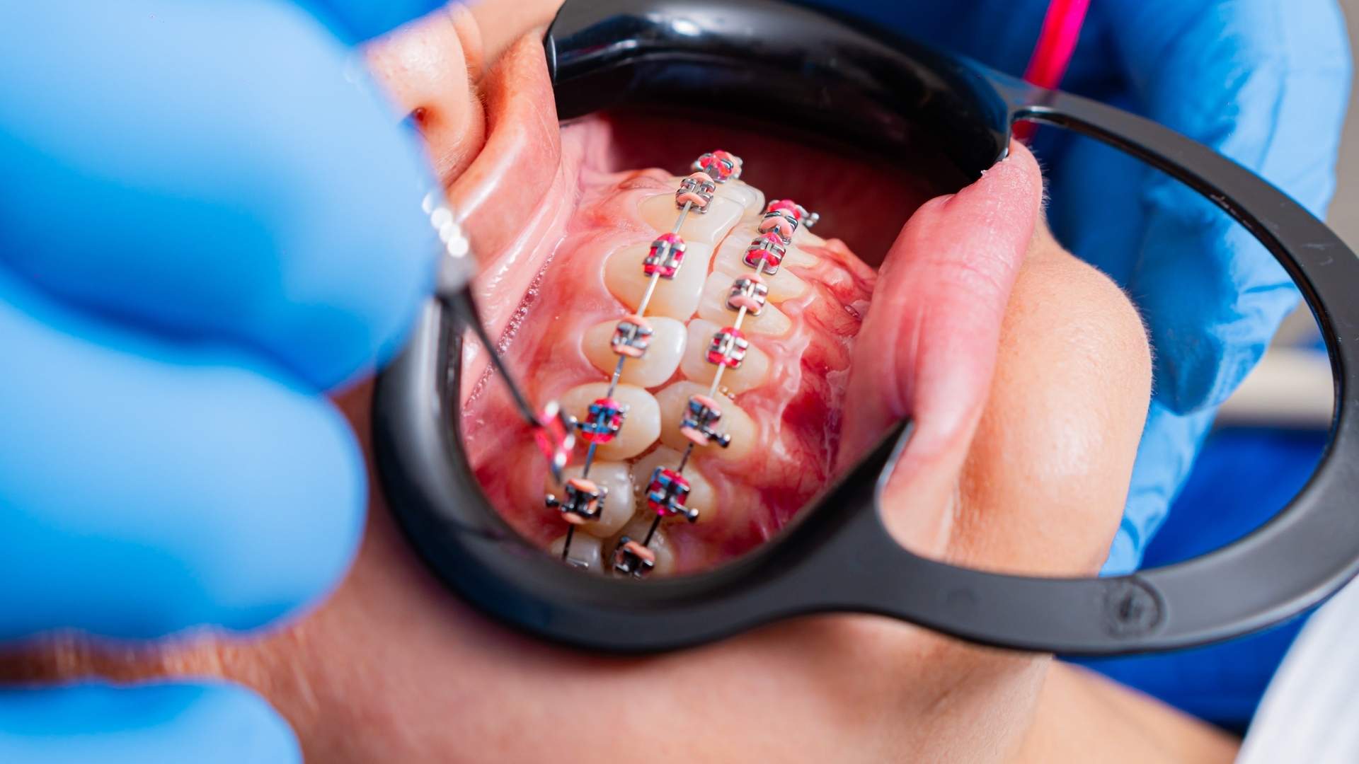 Persona en una revisión de brackets