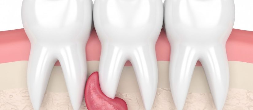 Un quiste dental en muelas