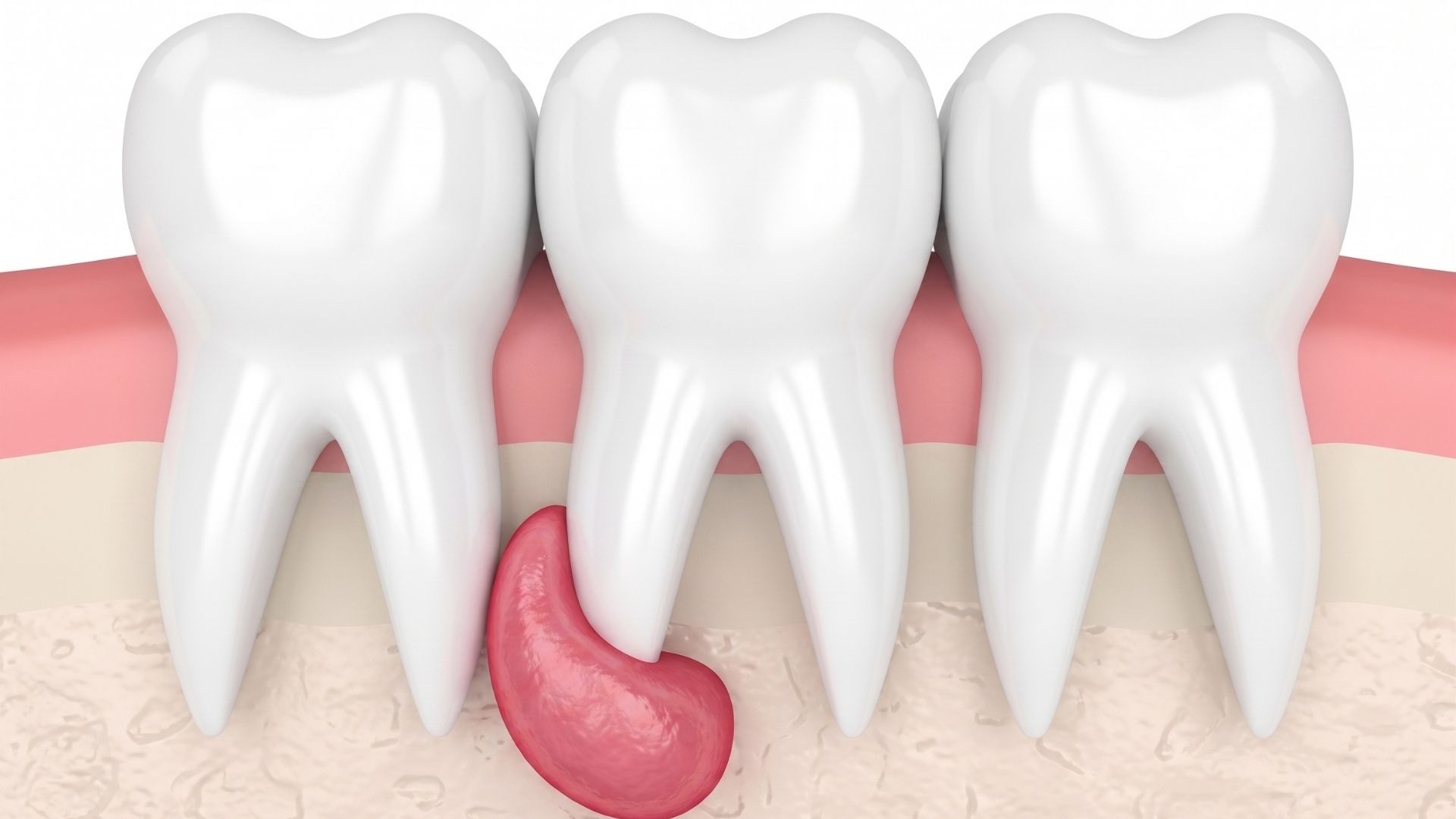 Un quiste dental en muelas